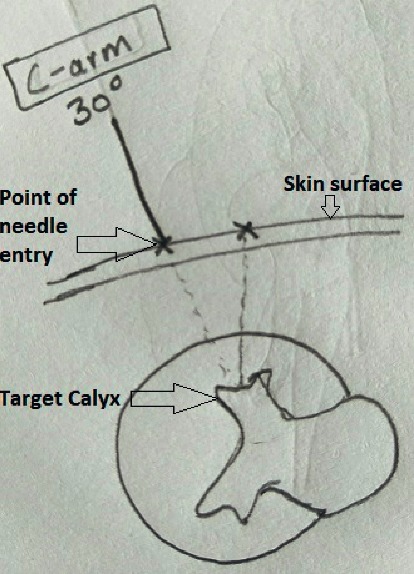 Percutaneous Nephrolithotomy: Challenges for a Novice Urologist.