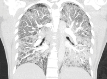 E-Cigarette- and Vaping-Related Lung Injury (EVALI) at a Regional Hospital System in South Carolina.