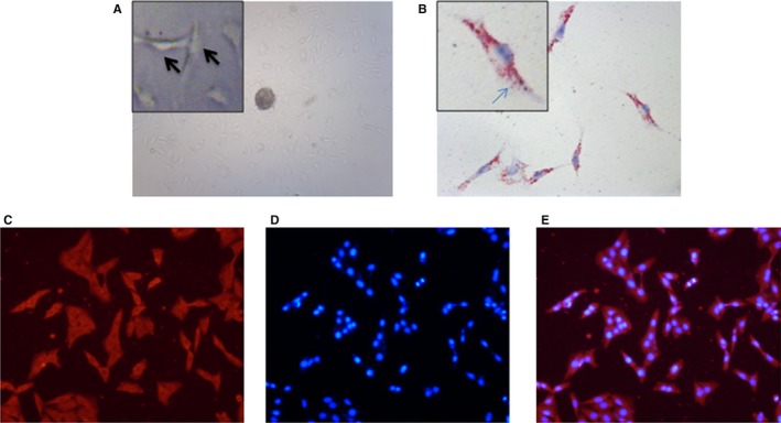 NGF from pancreatic stellate cells induces pancreatic cancer proliferation and invasion by PI3K/AKT/GSK signal pathway.