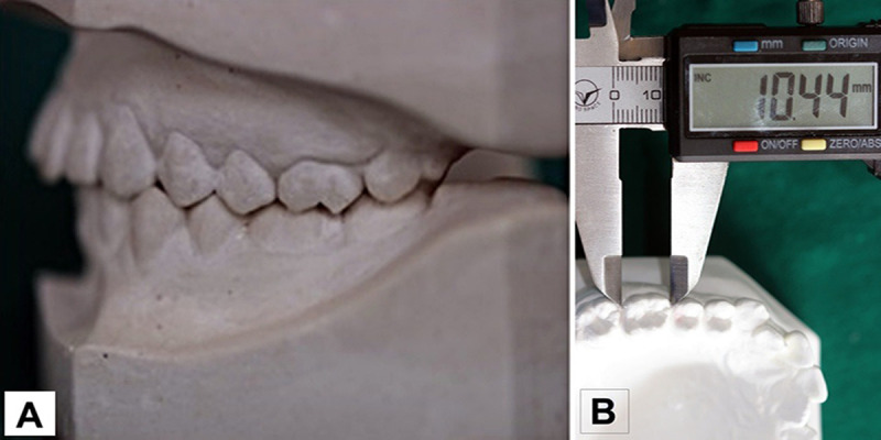 Bolton's analysis using a photogrammetric method on occlusal photographs.