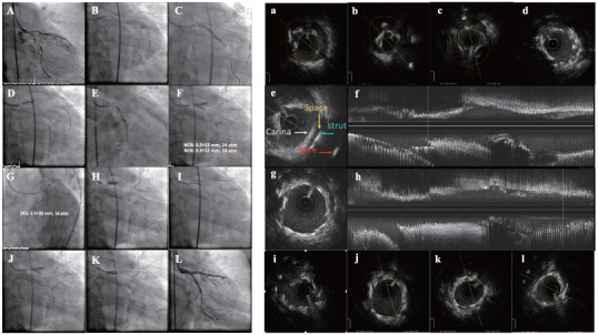 Intravascular Ultrasound-guided Versus Angiography-guided Percutaneous Coronary Intervention: Evidence from Observational Studies and Randomized Controlled Trials.