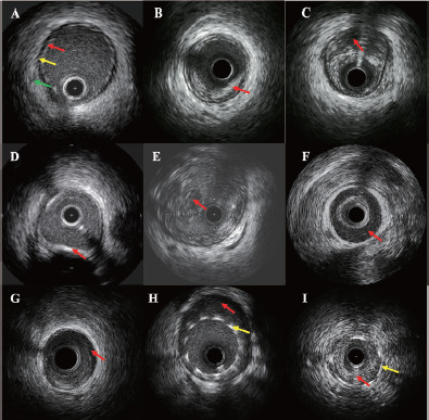 Intravascular Ultrasound-guided Versus Angiography-guided Percutaneous Coronary Intervention: Evidence from Observational Studies and Randomized Controlled Trials.