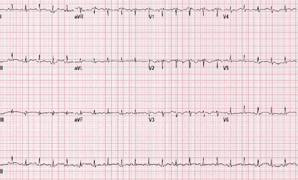 Postpartum Pulmonary Hypertension Masquerading as Submassive Pulmonary Embolism: A Case Report and a Literature Review.