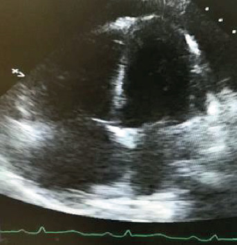 Postpartum Pulmonary Hypertension Masquerading as Submassive Pulmonary Embolism: A Case Report and a Literature Review.