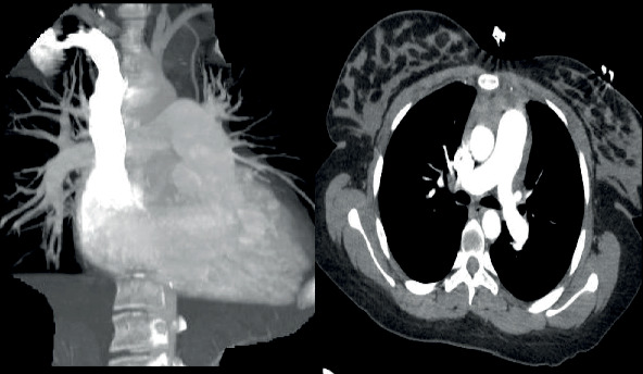 Postpartum Pulmonary Hypertension Masquerading as Submassive Pulmonary Embolism: A Case Report and a Literature Review.