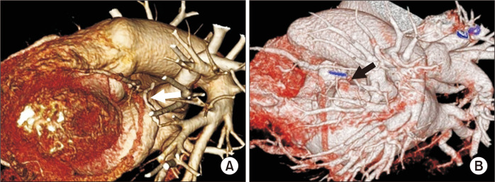 Safety and Efficacy of Left Atrial Appendage Excision Using a Vascular Stapler.