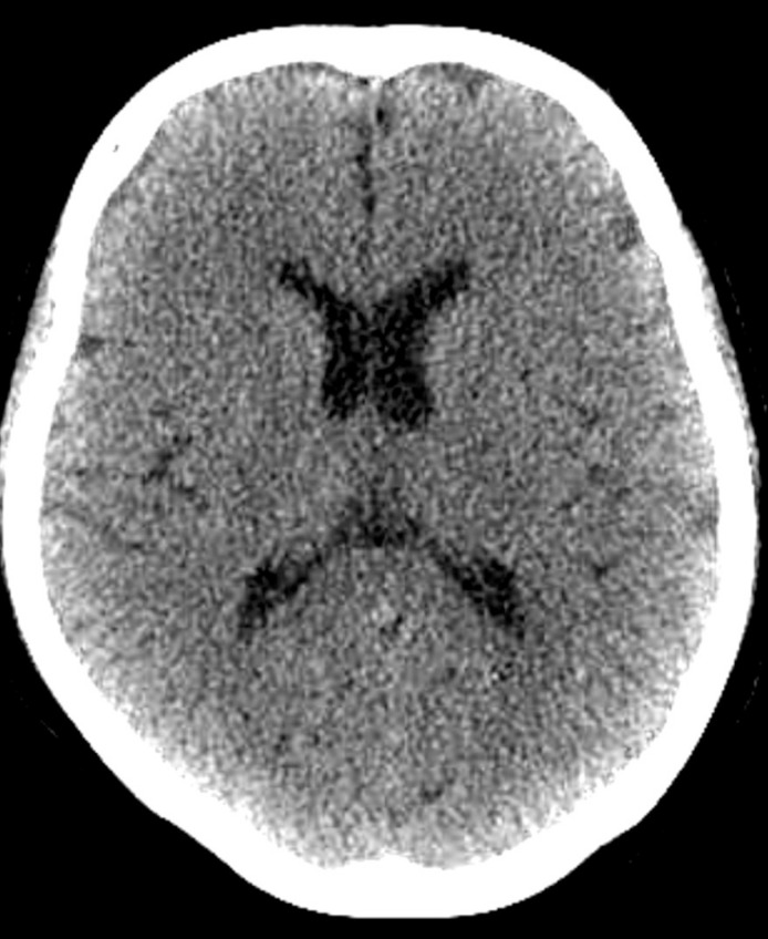 Recurrent Severe Hyponatremia in a Patient with Sjögren's Syndrome.