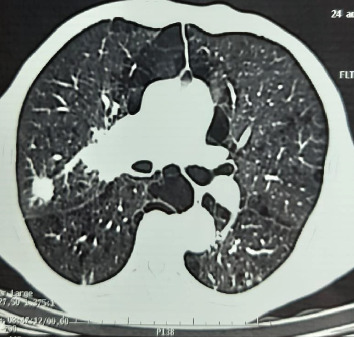 A Rare Paraneoplastic Syndrome of Lung Cancer.