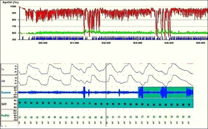 MPV promote adherence to nocturnal NIV in a Duchenne patient.