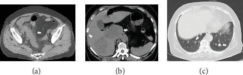 Readministration of Cancer Drugs in a Patient with Chemorefractory Metastatic Colorectal Cancer.