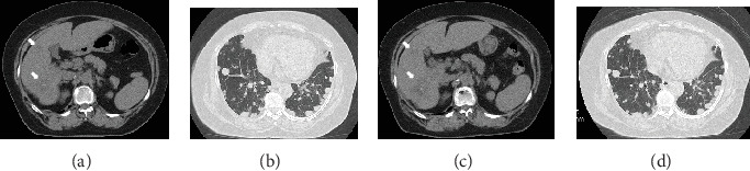 Readministration of Cancer Drugs in a Patient with Chemorefractory Metastatic Colorectal Cancer.