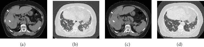 Readministration of Cancer Drugs in a Patient with Chemorefractory Metastatic Colorectal Cancer.