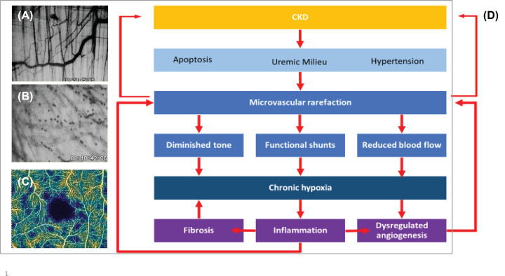 Microvascular disease in chronic kidney disease: the base of the iceberg in cardiovascular comorbidity.