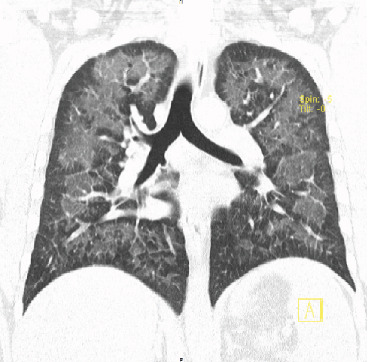 Review of Cases of E-Cigarette or Vaping Product Use-Associated Lung Injury (EVALI) and Brief Review of the Literature.