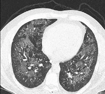 Review of Cases of E-Cigarette or Vaping Product Use-Associated Lung Injury (EVALI) and Brief Review of the Literature.