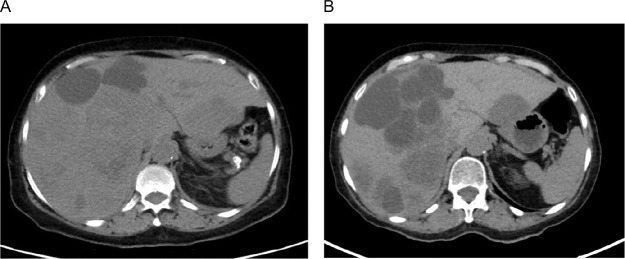 Resistance to Pembrolizumab and Axitinib in Renal Cell Carcinoma: Clinical and Genomic Evaluation.