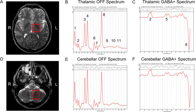 A pilot study of essential tremor: cerebellar GABA+/Glx ratio is correlated with tremor severity.