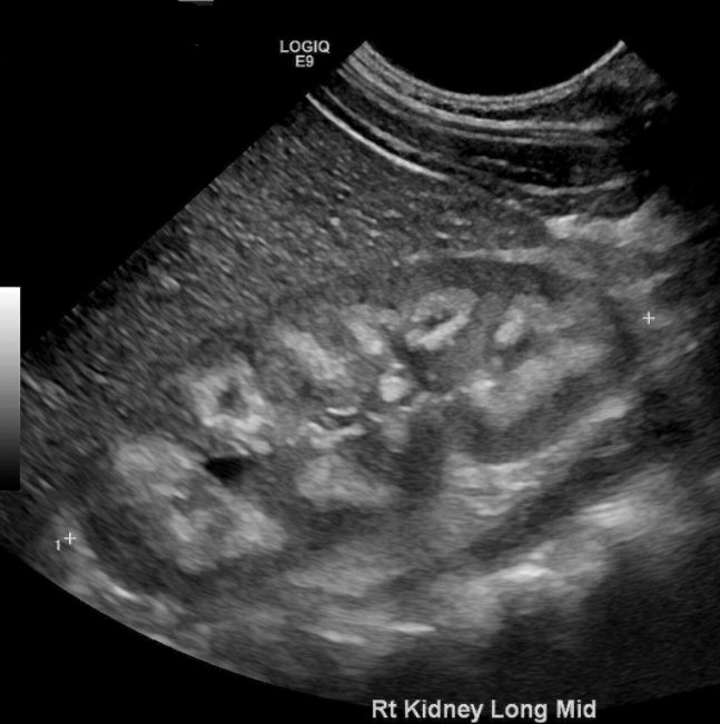 Skeletal Calcium Overload in Addition to Nephrocalcinosis in Severe Hypercalcemia