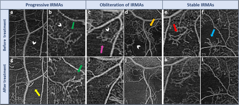 Morphological changes in intraretinal microvascular abnormalities after anti-VEGF therapy visualized on optical coherence tomography angiography.