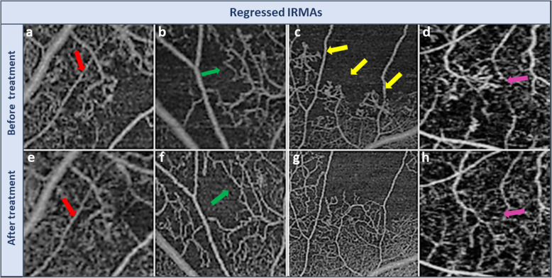 Morphological changes in intraretinal microvascular abnormalities after anti-VEGF therapy visualized on optical coherence tomography angiography.