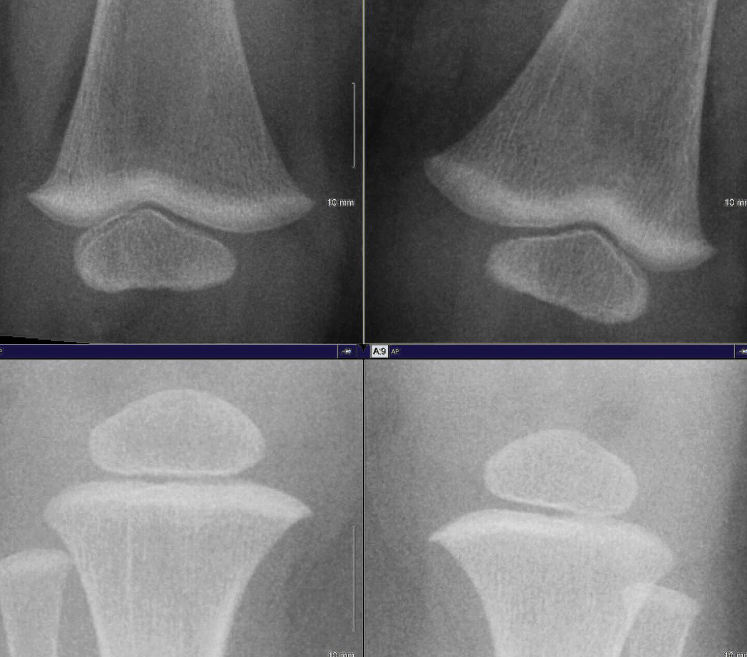 Skeletal Calcium Overload in Addition to Nephrocalcinosis in Severe Hypercalcemia