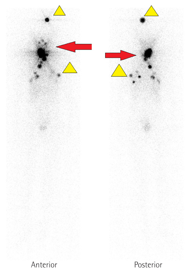 Poorly differentiated thyroid carcinoma: An institutional experience.