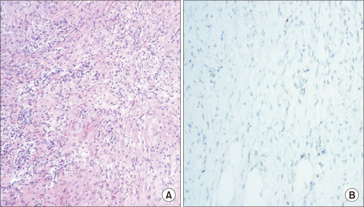 Cardiac Autotransplantation with Concurrent Pneumonectomy for Complete Resection of Primary Cardiac Intimal Sarcoma.