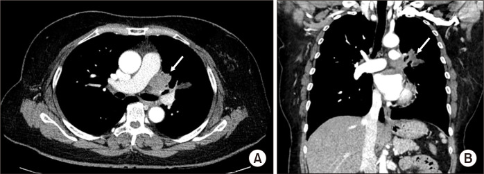 Cardiac Autotransplantation with Concurrent Pneumonectomy for Complete Resection of Primary Cardiac Intimal Sarcoma.