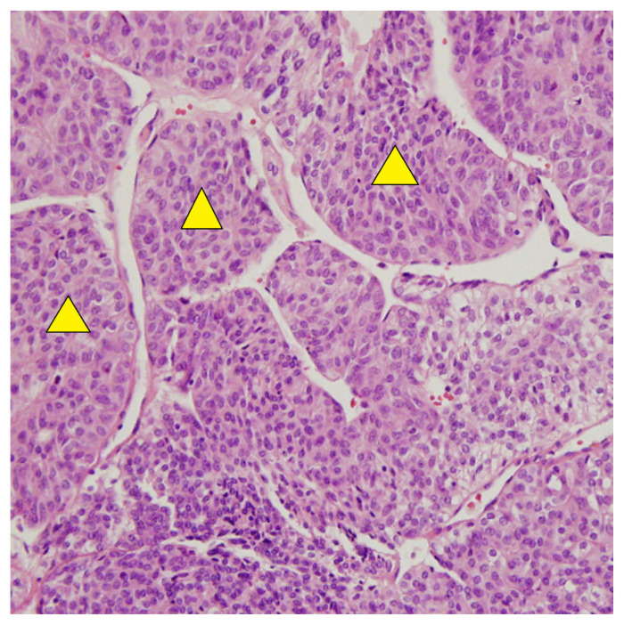 Poorly differentiated thyroid carcinoma: An institutional experience.