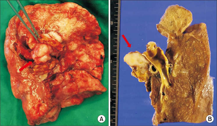 Cardiac Autotransplantation with Concurrent Pneumonectomy for Complete Resection of Primary Cardiac Intimal Sarcoma.