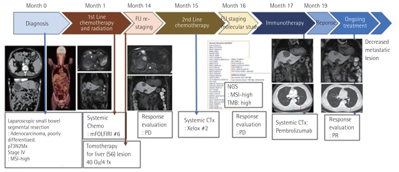 Clinical experience of immune checkpoint inhibitor for a metastatic jejunal cancer patient with a high tumor mutational burden and low expression of programmed death-ligand 1.