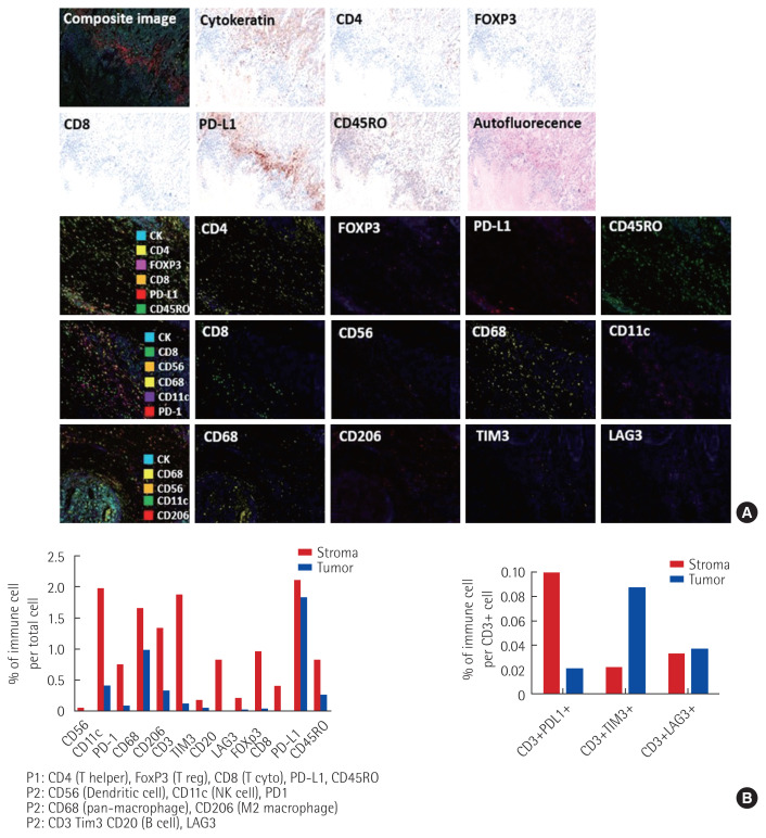 Clinical experience of immune checkpoint inhibitor for a metastatic jejunal cancer patient with a high tumor mutational burden and low expression of programmed death-ligand 1.