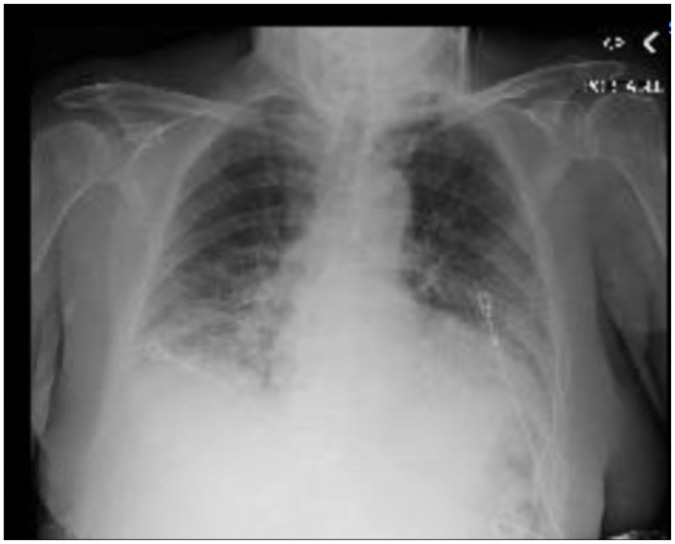 Bevacizumab-Induced Pneumonitis in a Patient With Metastatic Colon Cancer: A Case Report.