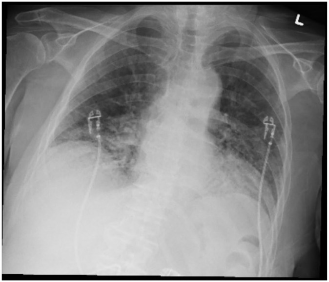 Bevacizumab-Induced Pneumonitis in a Patient With Metastatic Colon Cancer: A Case Report.