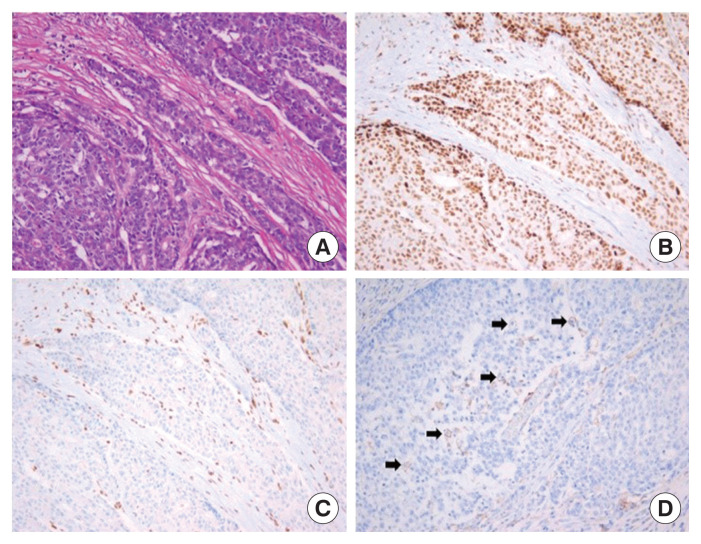 Clinical experience of immune checkpoint inhibitor for a metastatic jejunal cancer patient with a high tumor mutational burden and low expression of programmed death-ligand 1.