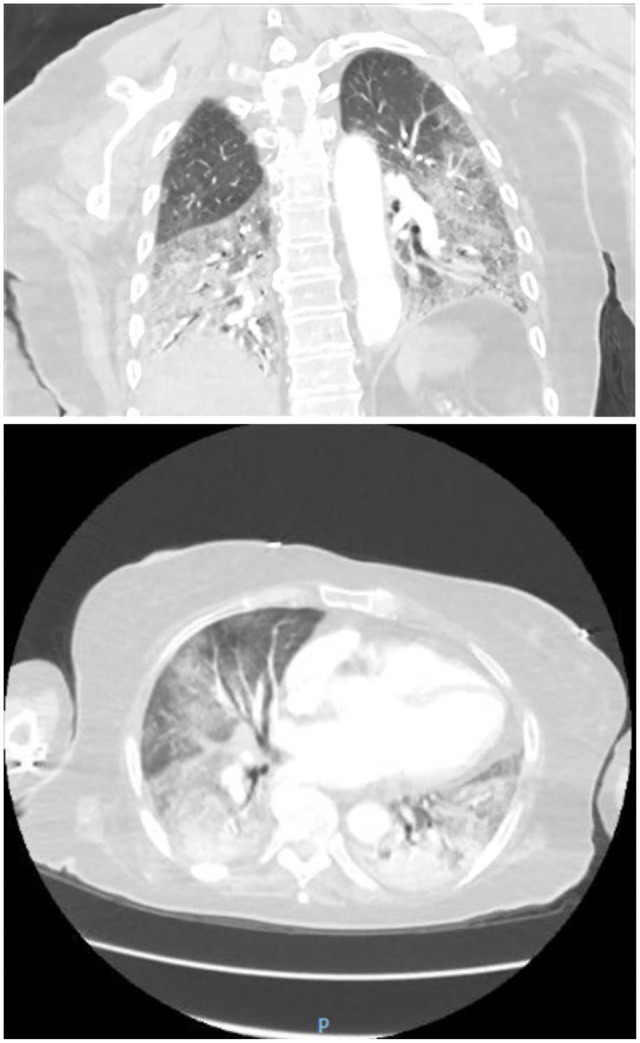 Bevacizumab-Induced Pneumonitis in a Patient With Metastatic Colon Cancer: A Case Report.