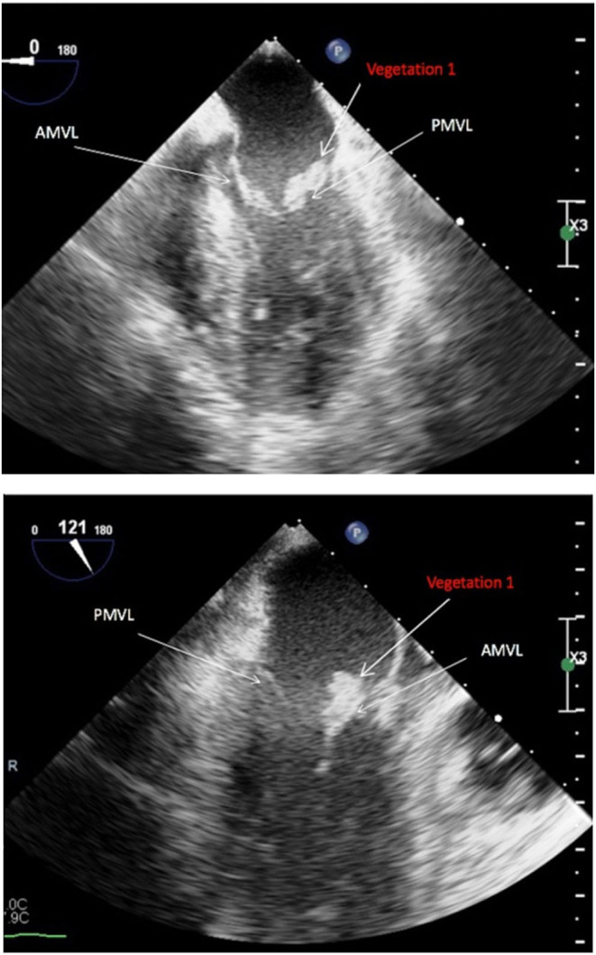 Unique characterization of complex endocarditic vegetations using 3D TOE.