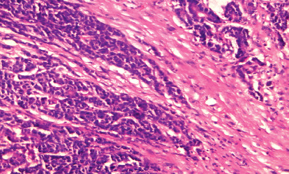 Predictive Factors of Positive Circumferential and Longitudinal Margins in Early T3 Colorectal Cancer Resection.