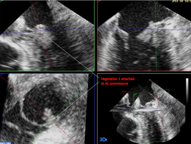 Unique characterization of complex endocarditic vegetations using 3D TOE.