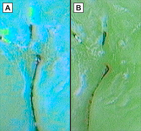 The Efficacy of Soprolife<sup>®</sup> in Detecting <i>in Vitro</i> Remineralization of Early Caries Lesions.