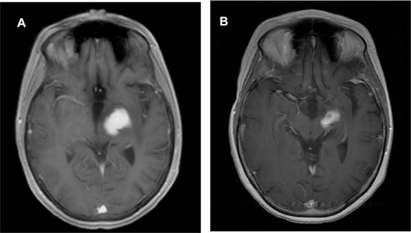 MEK inhibition with trametinib is a successful therapy in ganglioglioma.