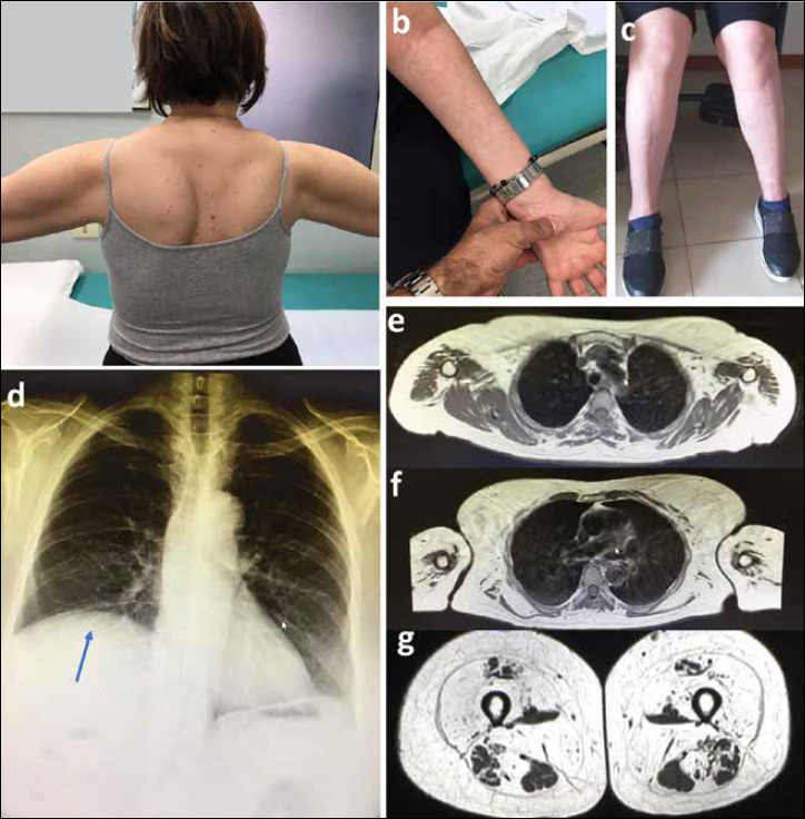 Respiratory muscle involvement in <i>HNRNPDL</i> LGMD D3 muscular dystrophy: an extensive clinical description of the first Italian patient.