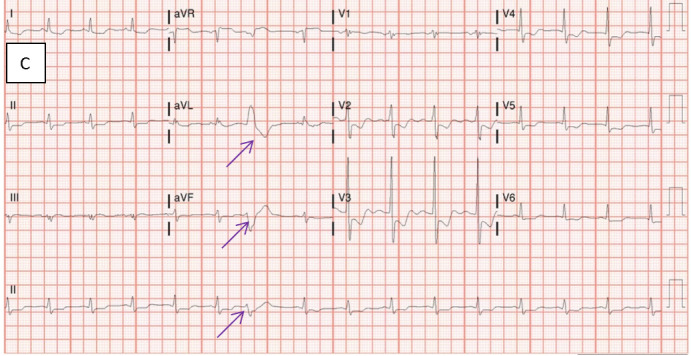 Myocardial Ischemia, a Rare Presentation of Meckel's Diverticulum.