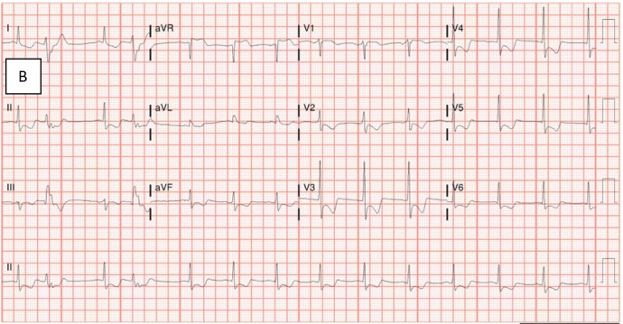 Myocardial Ischemia, a Rare Presentation of Meckel's Diverticulum.