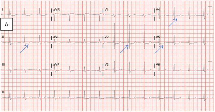 Myocardial Ischemia, a Rare Presentation of Meckel's Diverticulum.