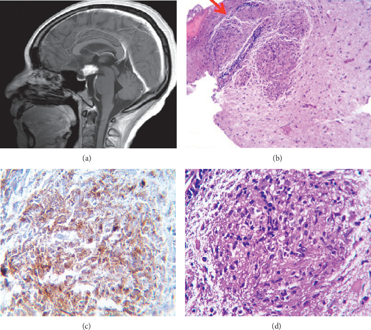 Neurosarcoidosis Presentation as Adipsic Diabetes Insipidus Secondary to a Pituitary Stalk Lesion and Association with Anti-NMDA Receptor Antibodies.