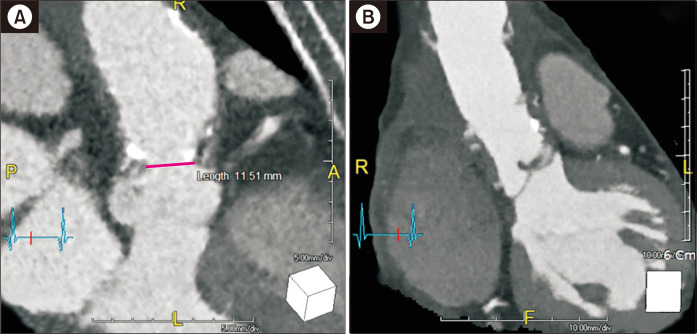 Aortic Valve-Sparing Surgical Treatment of Supravalvar Aortic Stenosis in a 65-Year-Old Adult.