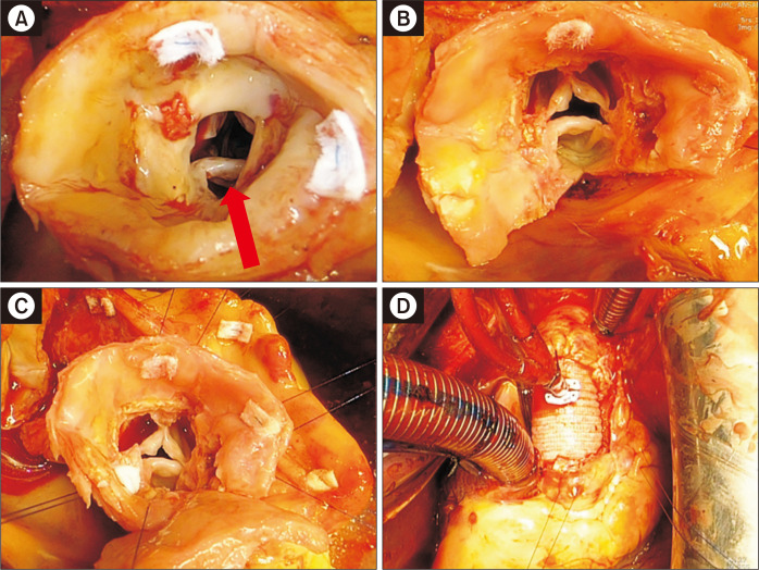 Aortic Valve-Sparing Surgical Treatment of Supravalvar Aortic Stenosis in a 65-Year-Old Adult.