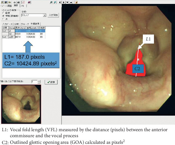 Comparison of the Effects of Desflurane, Sevoflurane, and Propofol on the Glottic Opening Area during Remifentanil-Based General Anesthesia Using a Supraglottic Airway Device.