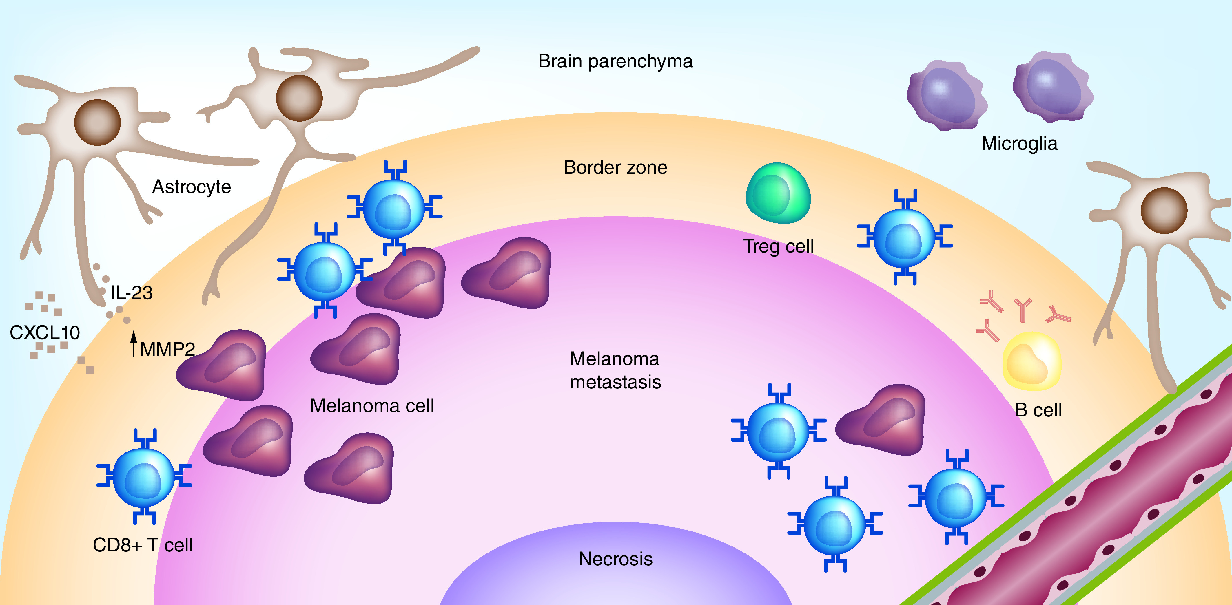 Melanoma brain metastases: review of histopathological features and immune-molecular aspects.